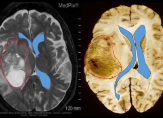 A study reveals details of a way the dangerous glioblastomas resist the effects of antiangiogenic drugs