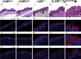 Interferon regulatory factor 6 (IRF6) are implicated in neural tube defects