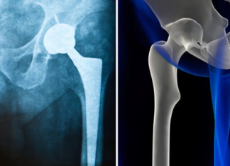 Researchers have discovered the reason that many people with joint replacements experience harmful inflammation and bone loss
