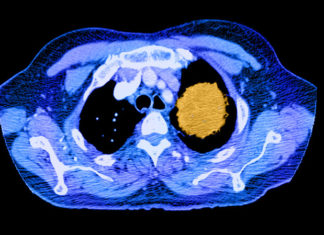 MIT cancer biologists have discovered a new mechanism that lung tumors exploit to promote their own survival