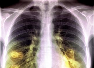 The world’s first genetic sequencing of precancerous lung lesions could pave the way for very early detection