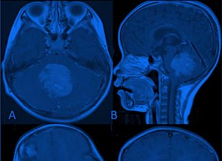 Scientists are making important progress in the battle against a class of devilishly complex human pediatric brain cancers