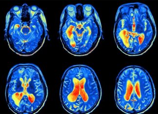 A targeted therapy that blocks a protein called LSD1 shrinks deadly pediatric brain tumors