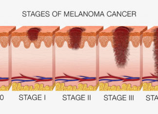 Stopping melanoma from spreading to other parts of the body might be as simple as cutting off the blood supply to the cancer