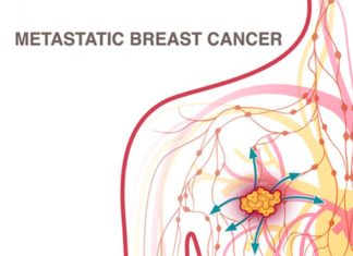 Breast cancer : Researchers identify drug against the formation of metastasis