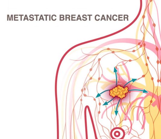 Breast cancer : Researchers identify drug against the formation of metastasis