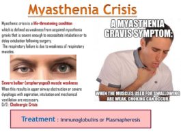 Surgery to remove the thymus gland in patients with myasthenia gravis (MG) provides significant clinical benefits as long as five years