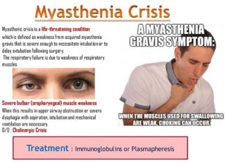 Surgery to remove the thymus gland in patients with myasthenia gravis (MG) provides significant clinical benefits as long as five years