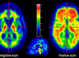 AI was able to predict, with 98% accuracy, which patients would develop Alzheimer’s disease, six years prior to diagnosis by analyzing PET brain scans