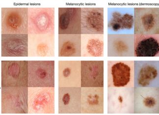 Research have discovered that squamous cell skin cancers do not require increased glucose
