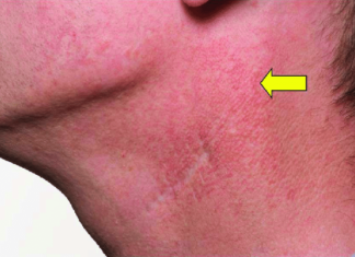 Researchers have identified a way to treat cutaneous fibrosis in cancer patients