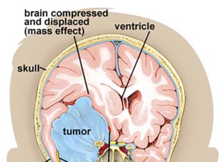 How does solid stress impacts the tissue surrounding brain tumors ?