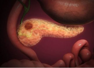 New pancreatic cancer screening may detect disease earlier