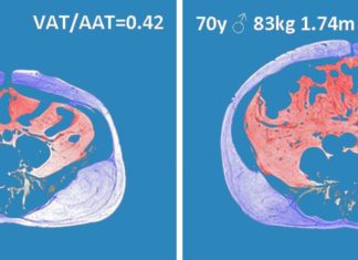 Visceral Adipose Tissue fat may cause pathogenic obesity