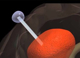 A biomedical tool llures aggressive brain tumor cells out of the patient