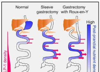 Bariatric surgery- Weight loss surgery changes the way our bodies sense food