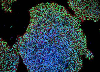 Researchers can generate insulin-producing beta cells from pluripotent stem cells (PSC) for treatment of type 1 diabetes