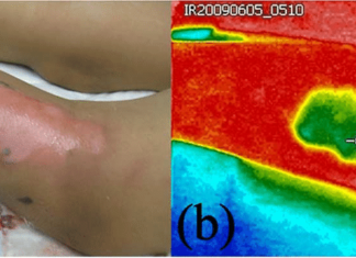 Digital thermograms to predict the best treatment for a patients with a burn