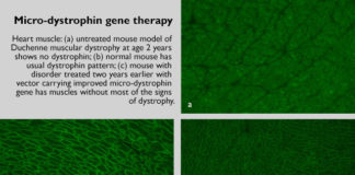 Experimental gene therapy cassettes for Duchenne muscular dystrophy have been modified to deliver better performance