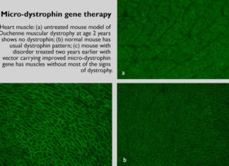 Experimental gene therapy cassettes for Duchenne muscular dystrophy have been modified to deliver better performance