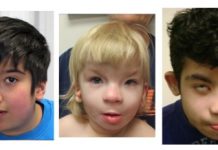 Geneticists discovered a potential therapy targeting for a severe autism-related disorder