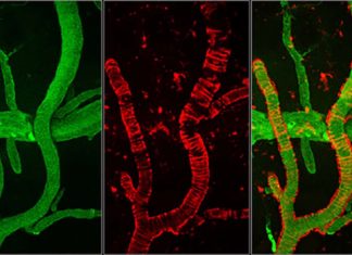 Fibrinogen : A new culprit of cognitive decline in Alzheimer’s disease