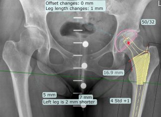 Hip and knee replacements : real success rate