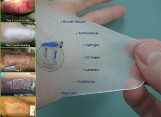 Israeli nanotechnology company cures burns without causing added pain