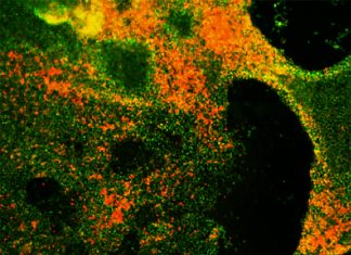 Researchers have used human embryonic stem cells to study the initiation and progression of small cell lung cancer (SCLC)