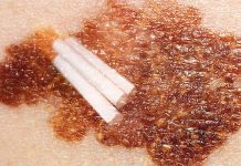 Melanoma patients with a history of smoking cigarettes are 40 per cent less likely to survive