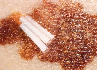 Melanoma patients with a history of smoking cigarettes are 40 per cent less likely to survive