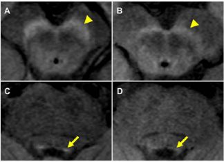 Magnetic resonance imaging (NM-MRI) is a potential biomarker for psychosis