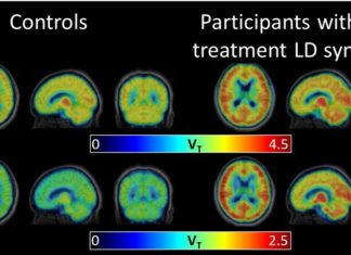 People successfully treated with antibiotics for Lyme disease go on to develop chronic symptoms of fatigue and brain fog