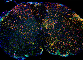 Previously unknown types of immune cells are present in the inflamed brain in the course of multiple sclerosis