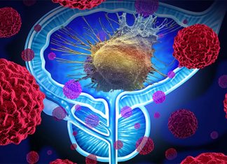Prostate cancer : starving out those hostile cancer cells is proving effective
