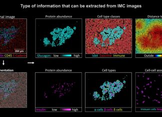 Researchers of UZH have investigated how type 1 diabetes gradually destroys insulin production