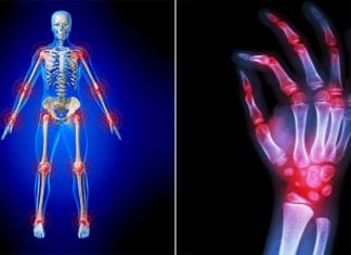 Rheumatoid arthritis: researchers have found a reversible molecular defect