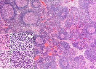 Healthy white blood cells, called T-cells play a crucial role in how the body fights follicular lymphoma