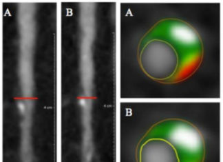 Treating psoriasis with biologic drugs that target immune system activity reduce the plaque buildup that clogs arteries
