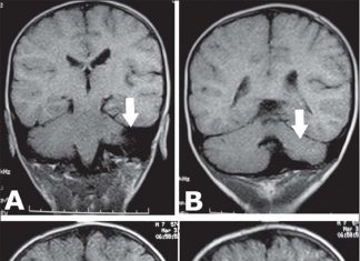 Researchers have discovered the mechanism of brain syndrome called disproportionate pontine and cerebellar hypoplasia (MICPCH)