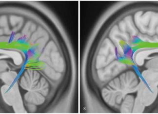 Stimulating the cingulum bundle during neurosurgery where people are awake results in immediate laughter, followed by a sense of calm and happiness in patients