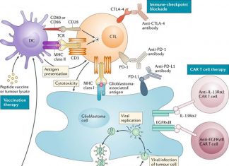 Glioblastoma – administering an immunotherapy drug before surgery is more effective than using the drug afterward