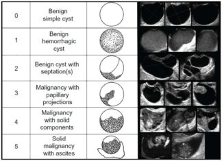 Women may not need to undergo surgery for non-cancerous ovarian cysts