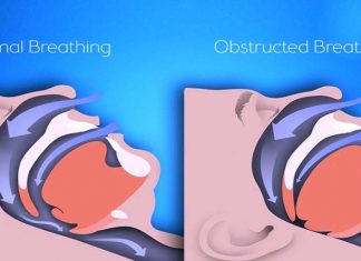 Researchers examined the link between obstructive sleep apnea syndrome (OSAS) and inflammation