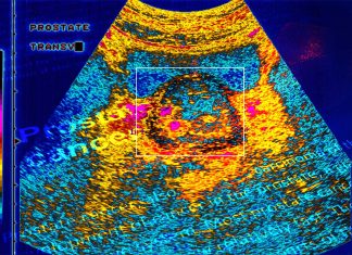 Prostate cancer : Researchers identify protein that contributes to racial disparities