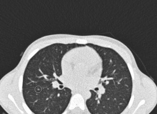 Small spots on CT scans of the lungs of children with Rhabdomyosarcoma do not have an adverse effect on survival