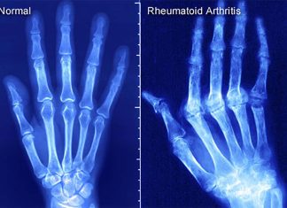A gene called ELMO1 alleviated rheumatoid arthritis symptoms