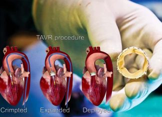 Aortic valve stenosis : study evidenced that TAVR is superior to surgery for low-risk patients