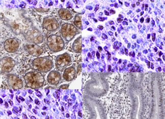 New hope treating resistant breast cancers with old drugs