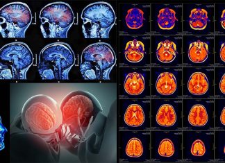 Brain Concussion : dizziness or vision problems linked to damage to the corpus callosum